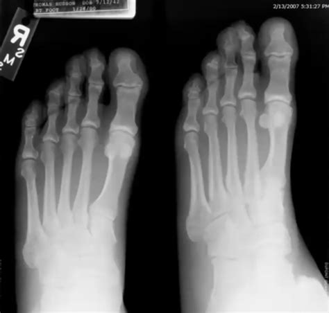 Msk Xray Clinical Reasoning Flashcards Quizlet