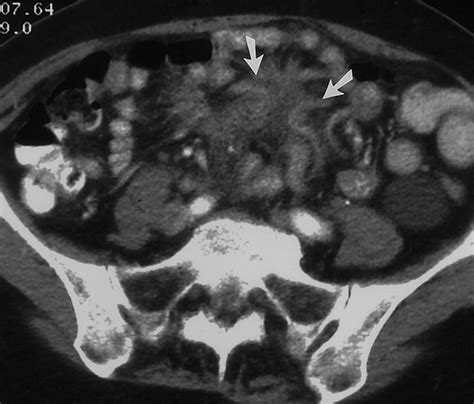 Mesenteric Neoplasms Ct Appearances Of Primary And Secondary Tumors And Differential Diagnosis