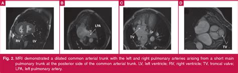 Figure 1 From Unrepaired Persistent Truncus Arteriosus In A 38 Year Old