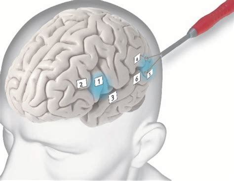 1speech Mapping In Awake Functional Mapping Eloquent Cortex