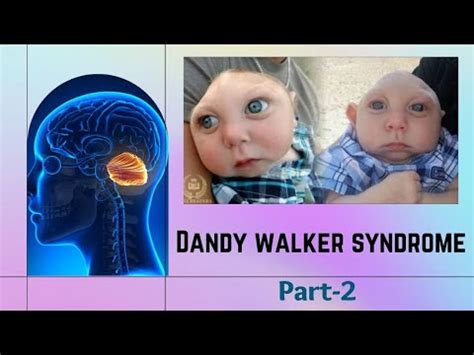 DANDY WALKER SYNDROME || PART-2 || PEDIATRIC NEUROLOGY || CONGENITAL ...