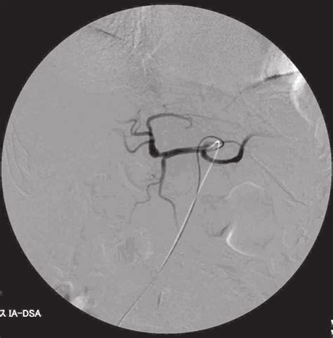 B Postoperative Digital Subtraction Angiography Showed A Patent Proper