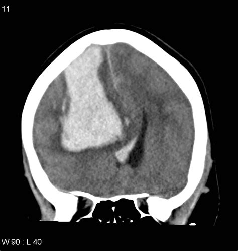 Lobar Hemorrhage Image