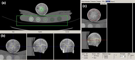 Quantitative Computed Tomography Qct In The Steps A Extraction B