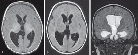 Porencephalic Cyst Mri