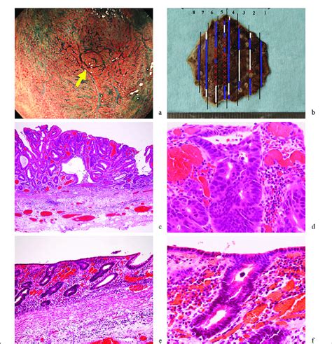 Endoscopic And Pathological Findings Of The Initial Rectal