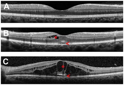 Optical Coherence Tomography Oct Scans Of The Human Macula In