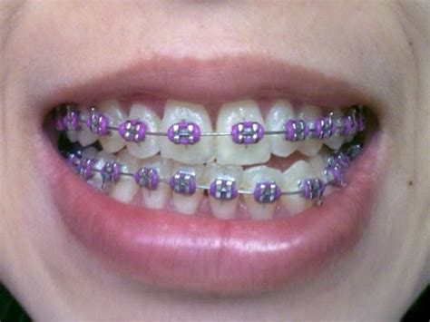 Fresh 25 of Braces Colors Light Purple | assuaradiobailao