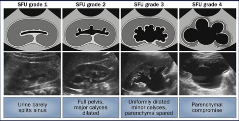 Prenatal Urinary Tract Dilatation Urologic Clinics