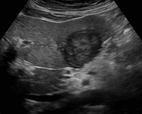 Wk 2 Liver Pathology Hcc Ultrasound Sonography Medical Ultrasound