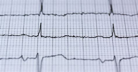 What Is Electrocardiography Ekgecg