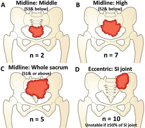 Schematic Illustration Demonstrating Gct Of The Sacrum Midline Tumor