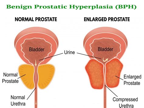 Benign Prostatic Hyperplasia