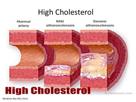 High Cholesterol How You Re Eating Your Way To Stroke Heart Diseases