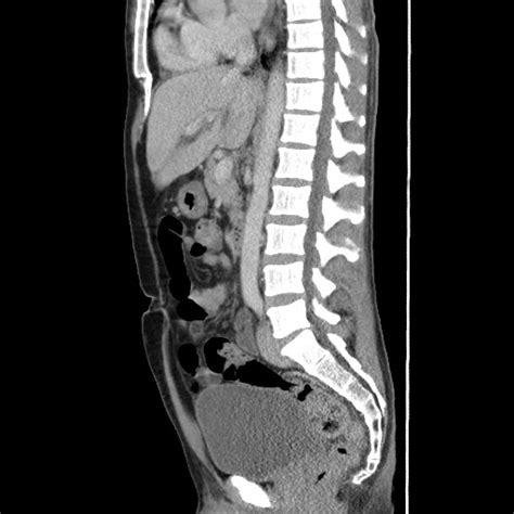 Amoebic Liver Abscesses Image