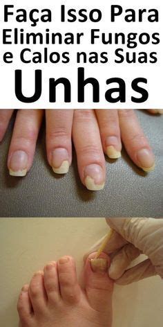 Como Fazer Um Rem Dio Caseiro Para Se Livrar De Fungos Nas Unhas