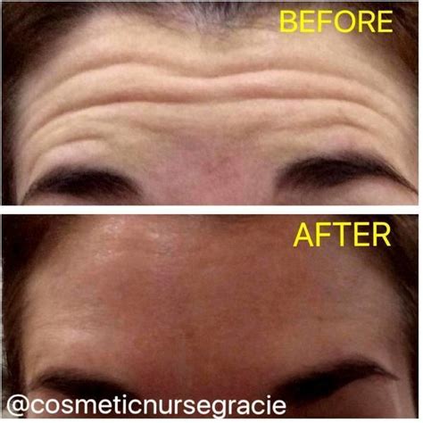 Botox Before And After Pictures Forehead (2) » Facelift: Info, Prices, Photos, Reviews, Q&A