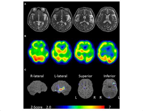 Brain Magnetic Resonance Imaging And Single Photon Emission Computed