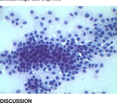 Figure 3 From Fine Needle Aspiration Cytology Of Salivary Gland