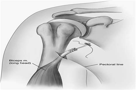 Subpectoral Biceps Tenodesis Using Dynamic Endobutton Fixati Techniques In Shoulder And Elbow