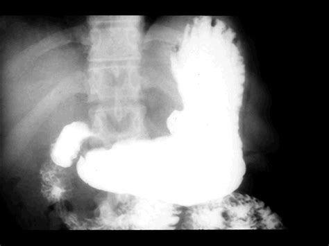 Duodenal Ulcer X Ray