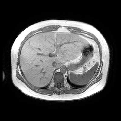 Radiology Cases: Diffuse Fatty Infiltration of the Liver