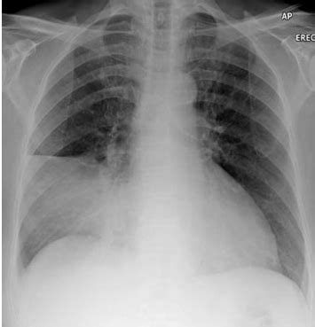 Pulmonology Block Chest X Ray And CT Findings Flashcards Quizlet