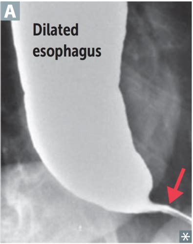 Esophageal Disorders Gi Exam Flashcards Quizlet