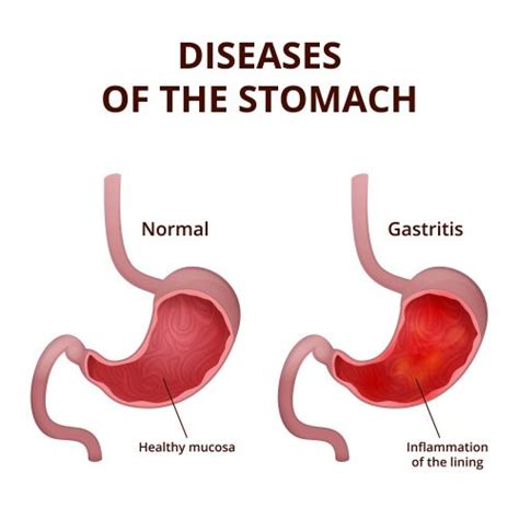 Stomach Polyps: Symptoms, Causes, Diet, Treatment | STD.GOV Blog