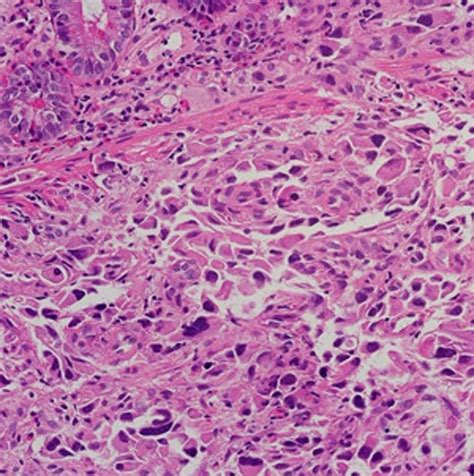 B. The pathological finding of metastatic poorly differentiated... | Download Scientific Diagram