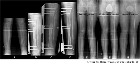 Deformidad Posteromedial De La Tibia Evolución Radiológica Y