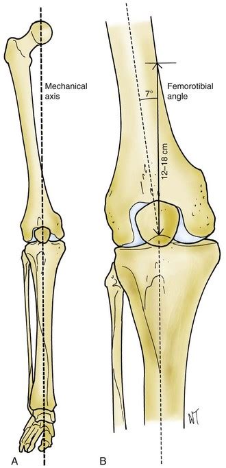 Surgical Techniques And Instrumentation In Total Knee Arthroplasty