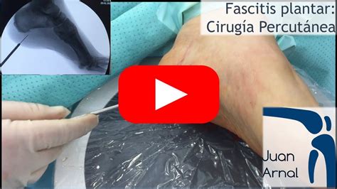 Fascitis Plantar Cirugia Minimamente Invasiva Youtube