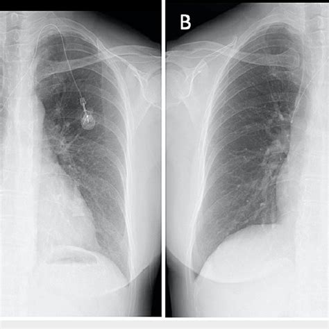 Chest Radiographic Images Of The Patient Chest X Ray Images A On