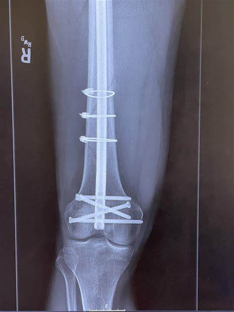 Femur, 10 weeks post-surgery. Fracture looks less distinct, callus ...