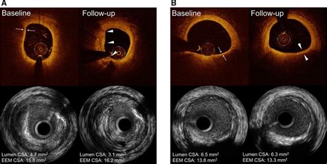 Serial Vessel Optical Coherence Tomography And Intravascular