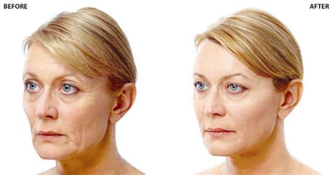 Fillers Vs Facelifts For Facial Rejuvenation The Pros And Cons