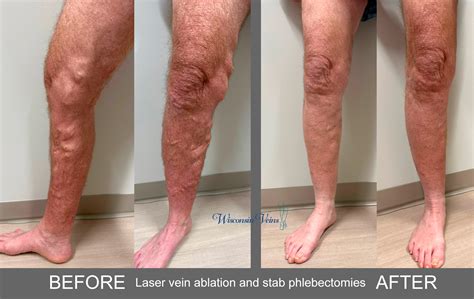 Laser Venous Ablation And Stab Phlebectomies Before And After