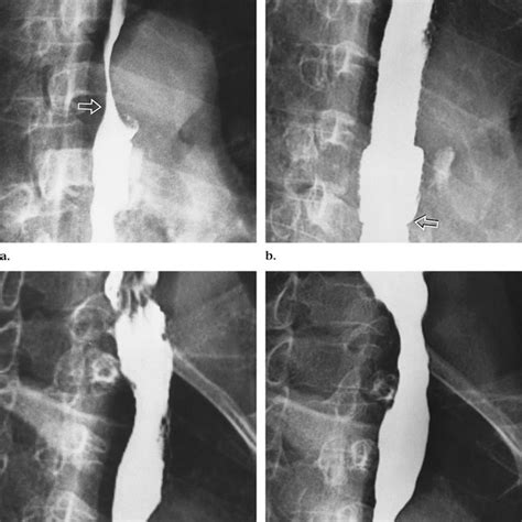 Photograph shows, from top to bottom, a type A stent, type B stent ...