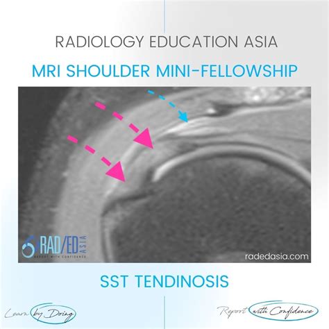 Rotator Cuff Supraspinatus Tendinosis Tendinitis Mri Whats Wrong With