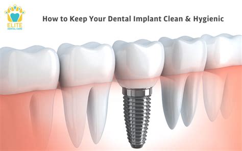 How To Keep Your Dental Implants Clean Hygienic Elite Dental Care