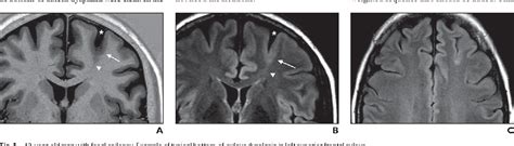 Figure From Bottom Of Sulcus Dysplasia Imaging Features