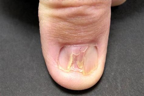 Nails Care: Lichen planus of nails Diseases