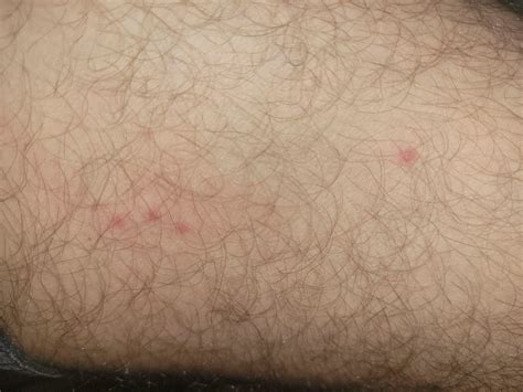 Lyme Disease Rash Rlyme