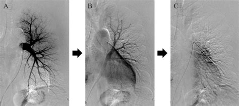 Figure5.Pulmonary angiography (PAG) images of the patient. The left ...