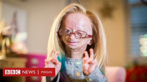 People With Progeria Lifespan