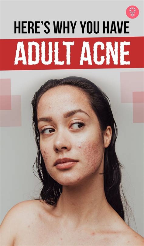 Adult Acne Skin Care Artofit