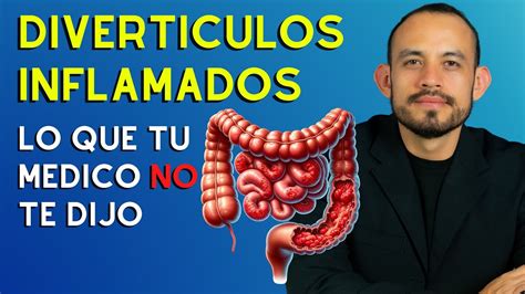 📛 Diverticulitis Síntomas Diagnostico Y Tratamiento 2024 Youtube