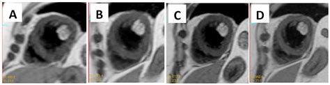 Three Year Follow Up Of Unresected Large Anterolateral Papillary Muscle