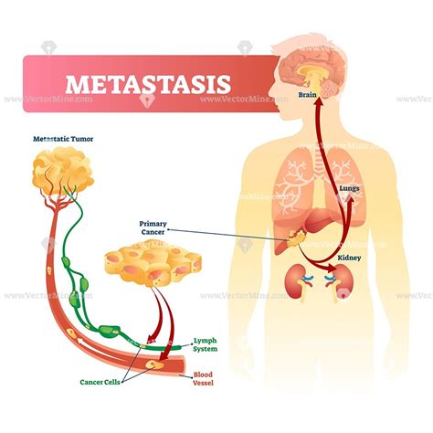 Metastasis vector illustration – VectorMine | Infographic health ...